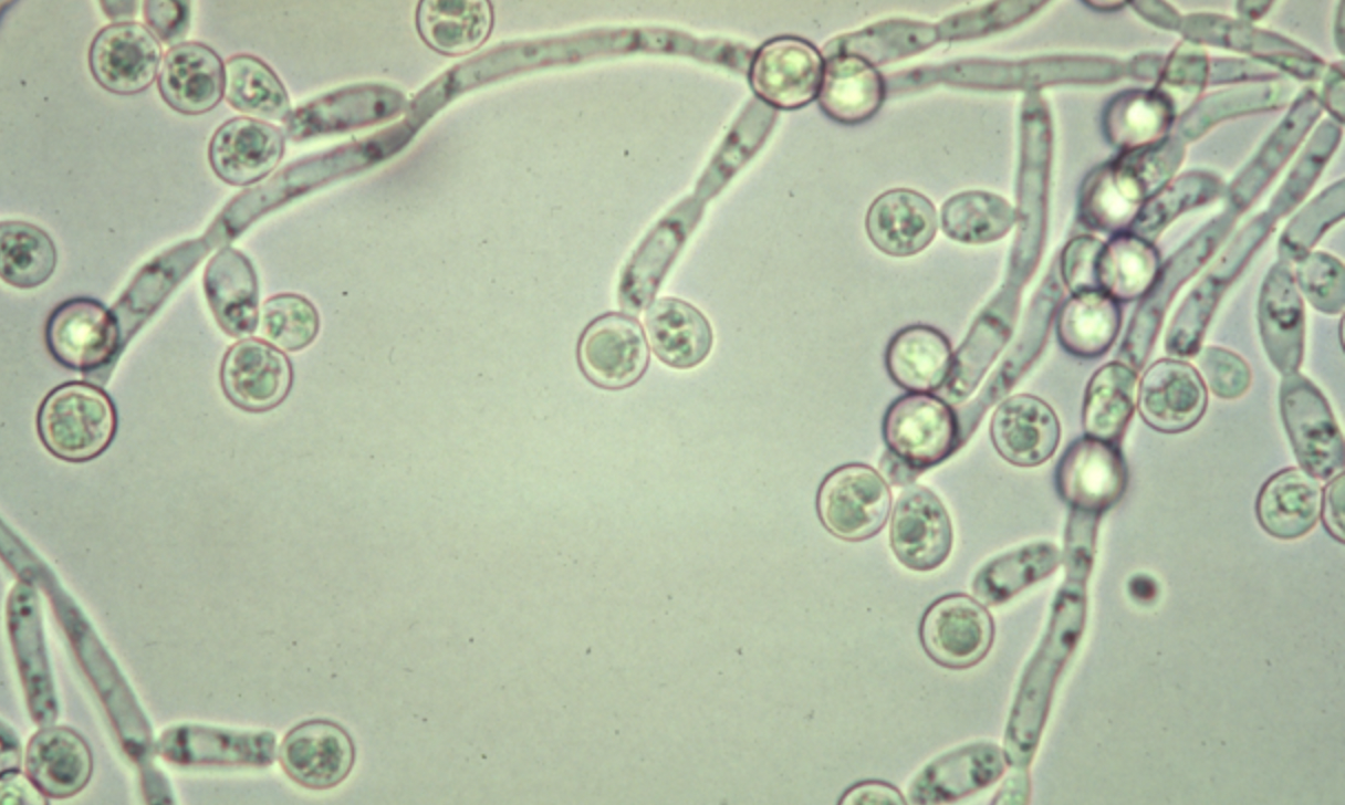 Understanding Candida: From Symptoms to Treatment. 6 Symptoms of ...