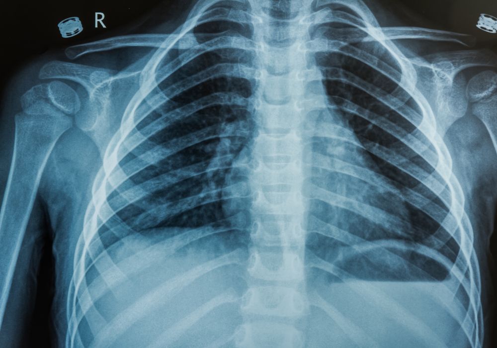 Chest Xrays Insights into Diagnosis and Interpretation Mezator